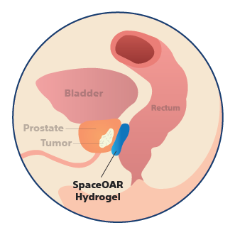 Anatomy with SpaceOAR Hydrogel